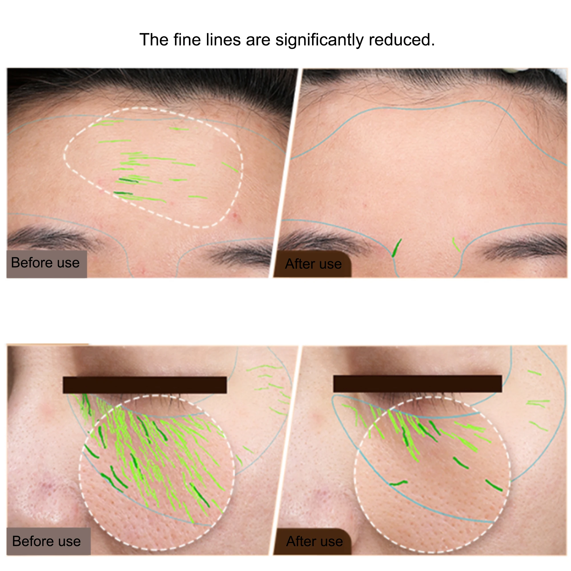 BrightLift RF+EMS Skin Sculptor – Targeted Tightening for Face & Body at Home - Image 2