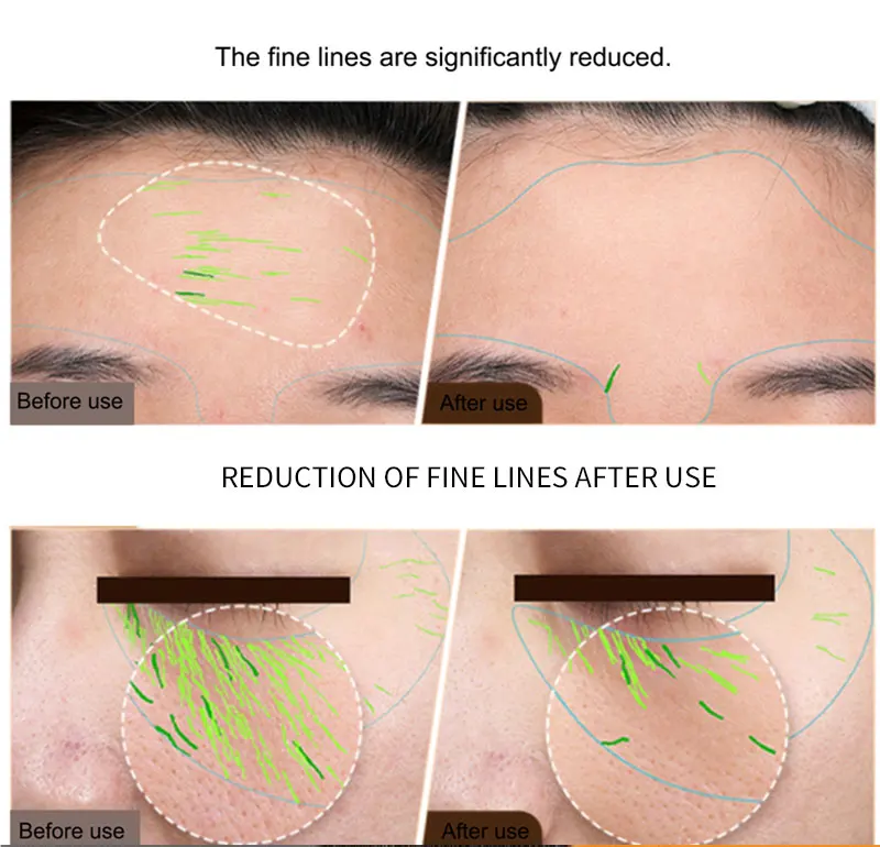 BrightLift RF+EMS Skin Sculptor – Targeted Tightening for Face & Body at Home - Image 16